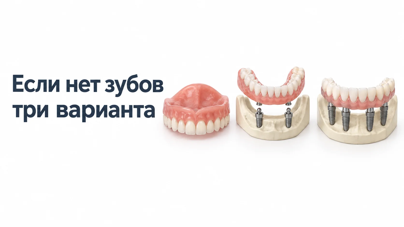 Три варианта протезирования: полный съёмный протез, съёмный протез на двух имплантах и несъёмный протез на четырёх имплантах