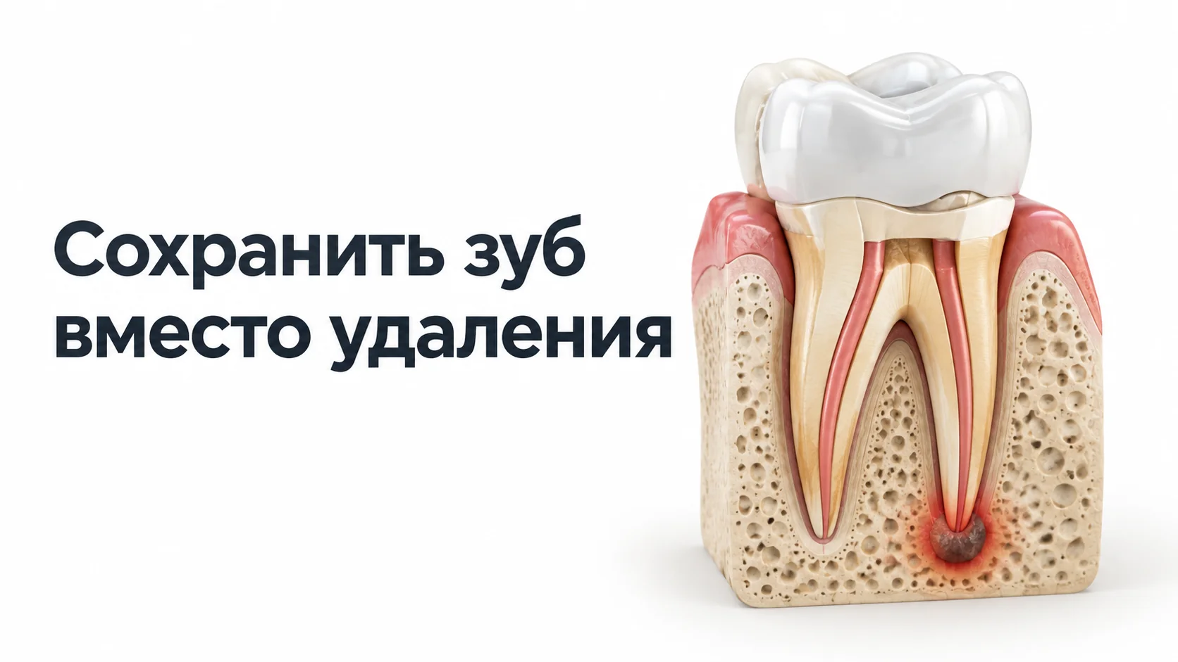 Модель моляра в разрезе: коронка, корни в кости и очаг воспаления у верхушки одного из корней