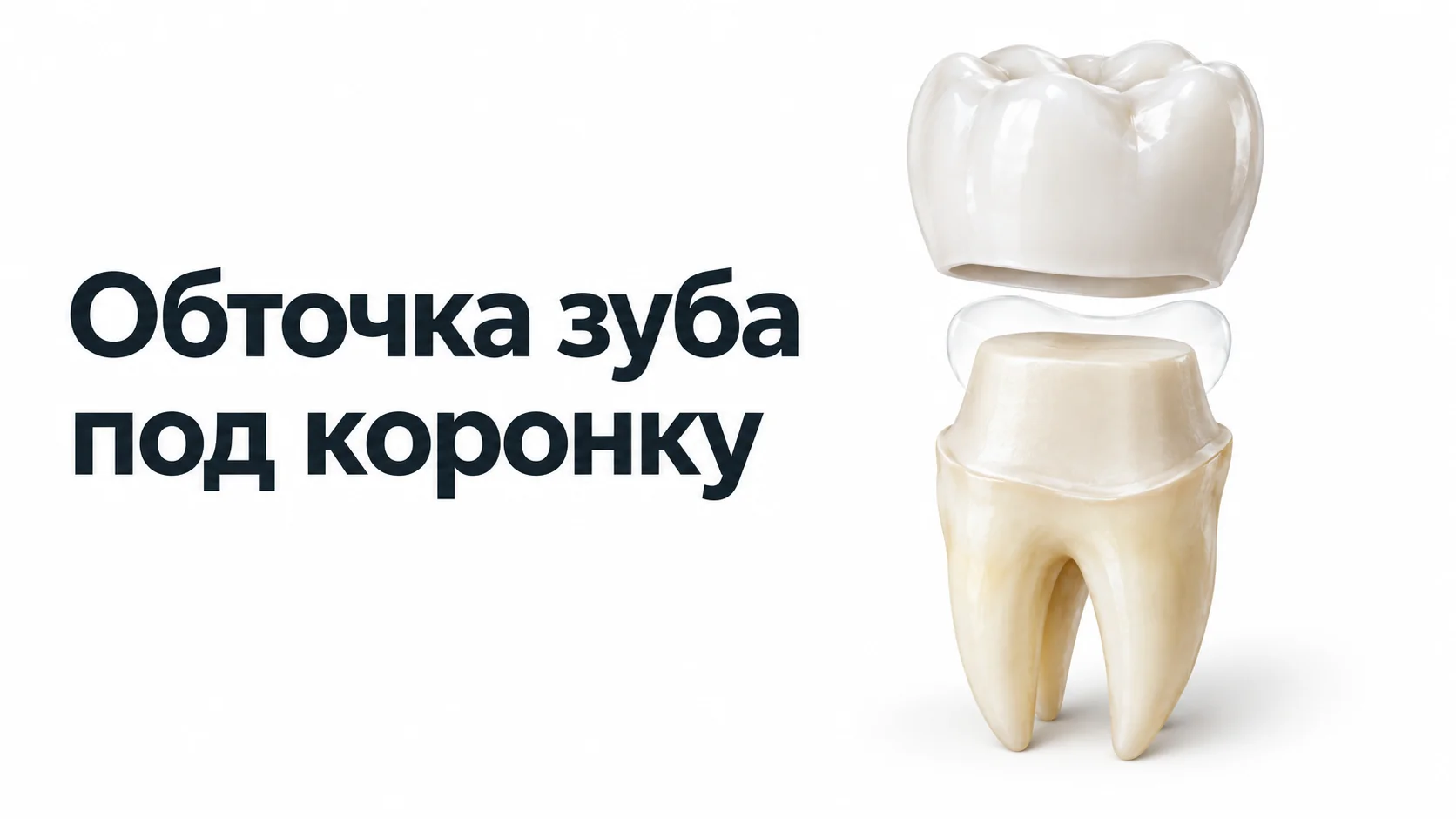 Обточенный жевательный зуб с ровным уступом по краю и керамическая коронка над ним