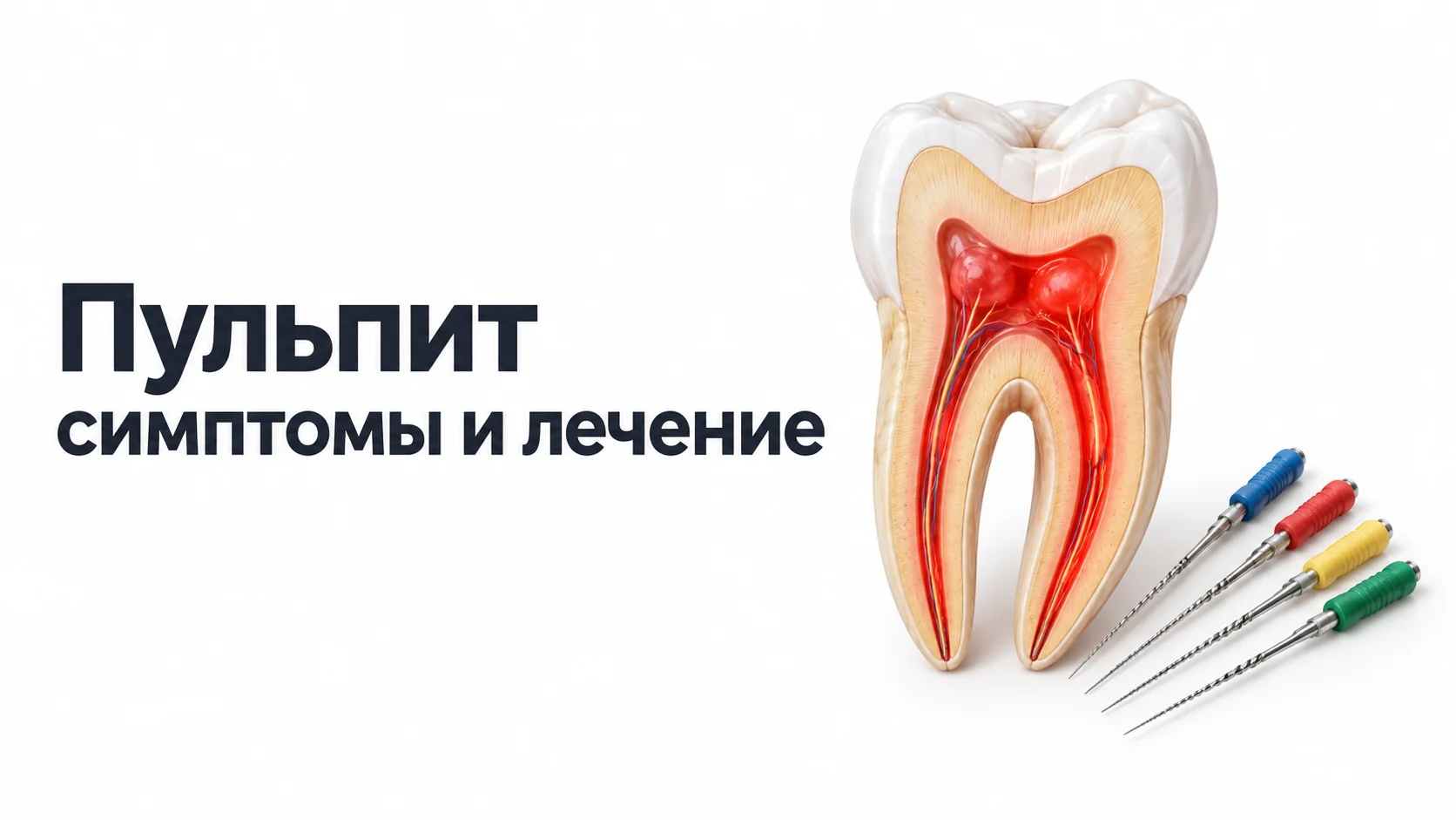 Модель моляра в разрезе с воспалённой пульпой и корневыми каналами, выделенными красным, рядом эндодонтические инструменты