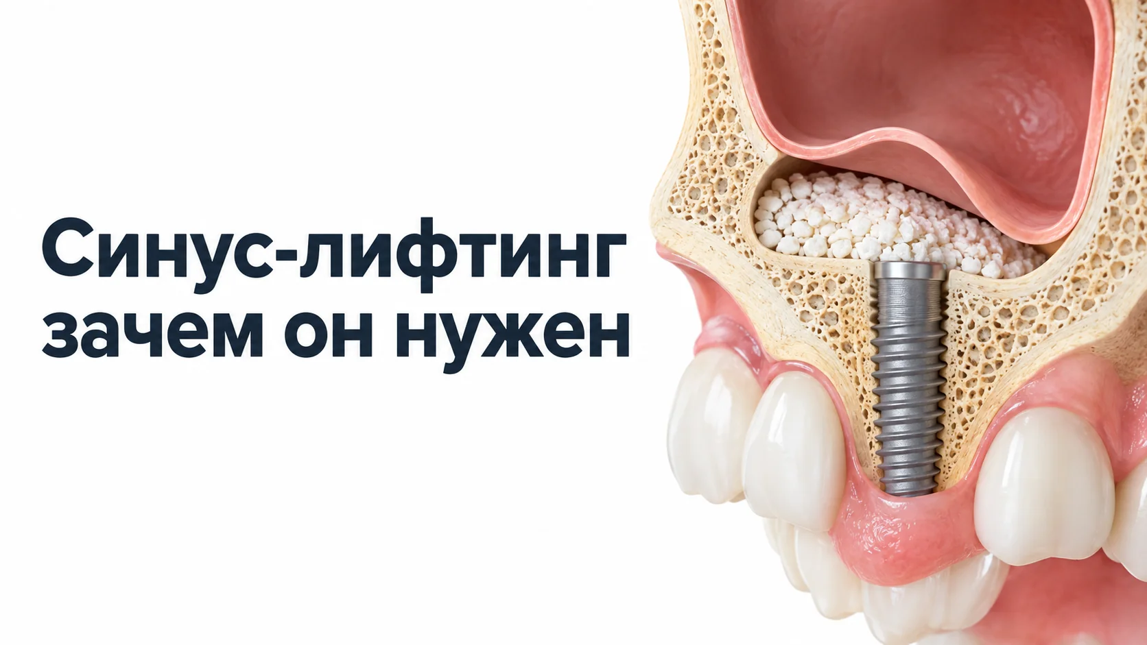Схема верхней челюсти в разрезе: приподнятая слизистая гайморовой пазухи, под ней костный материал и титановый имплантат